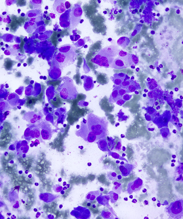 02 : Kidney TranslocationRCC