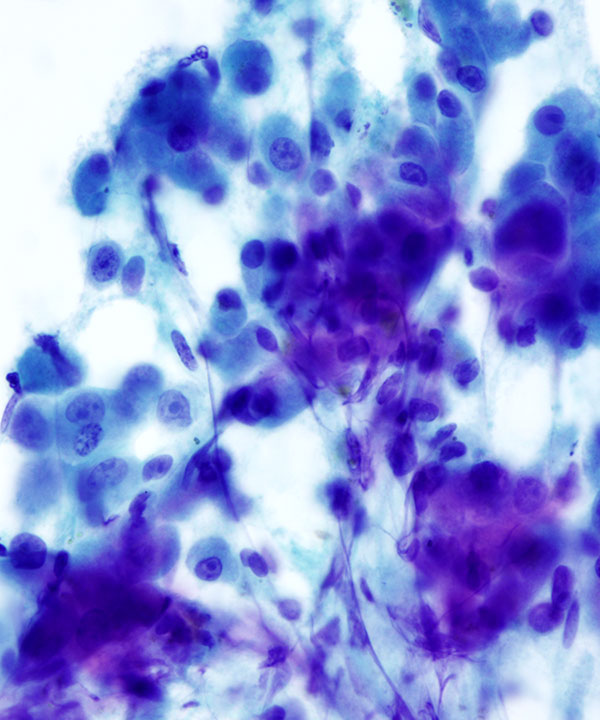 04 : Kidney TranslocationRCC
