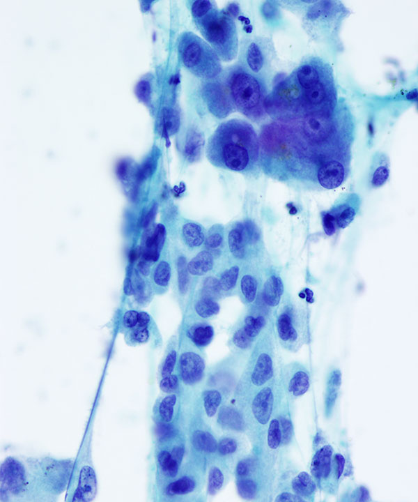 05 : Kidney TranslocationRCC