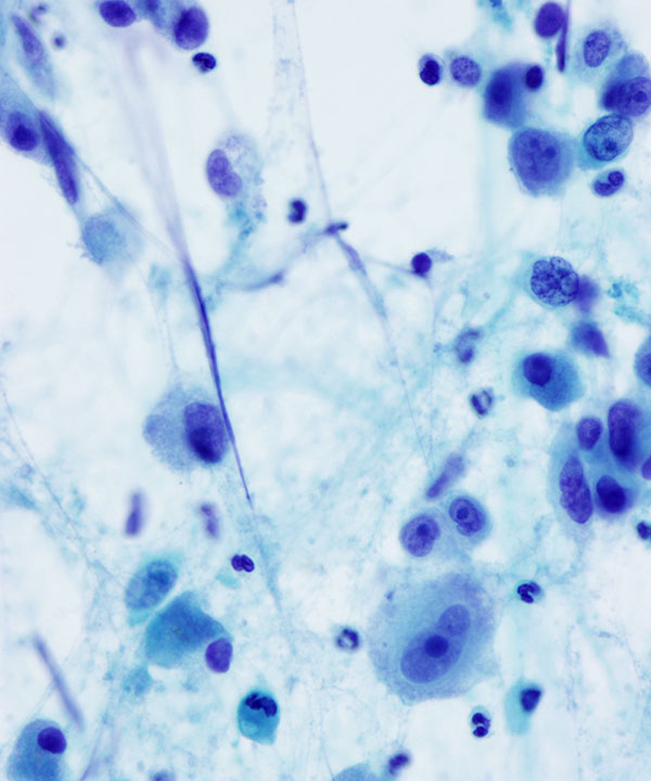 06 : Kidney TranslocationRCC