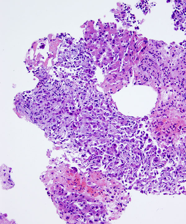 07 : Kidney TranslocationRCC