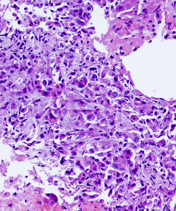 08 : Kidney TranslocationRCC