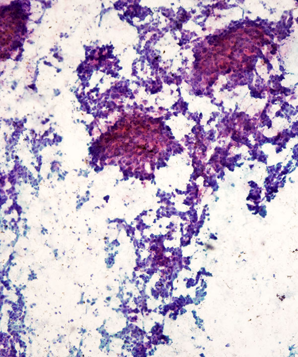 2 : Liver Adenoma