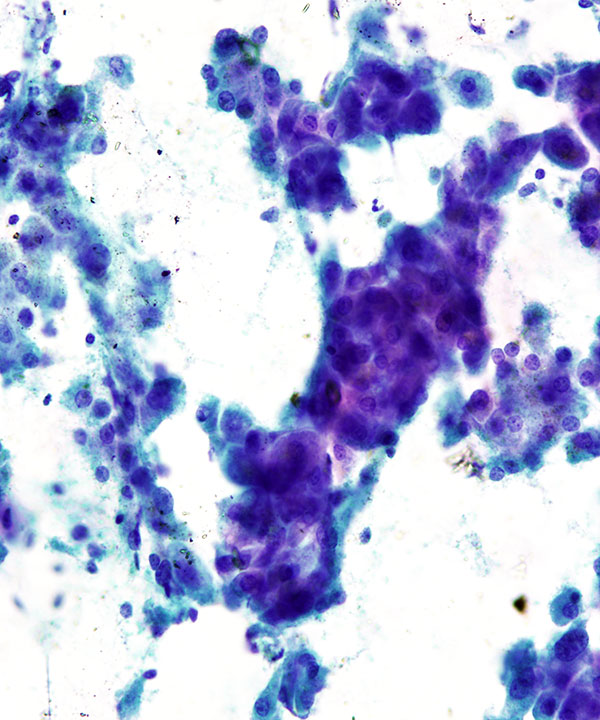 3 : Liver Adenoma