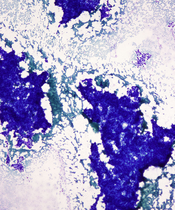 01 : Liver Hepatocellular Carcinoma