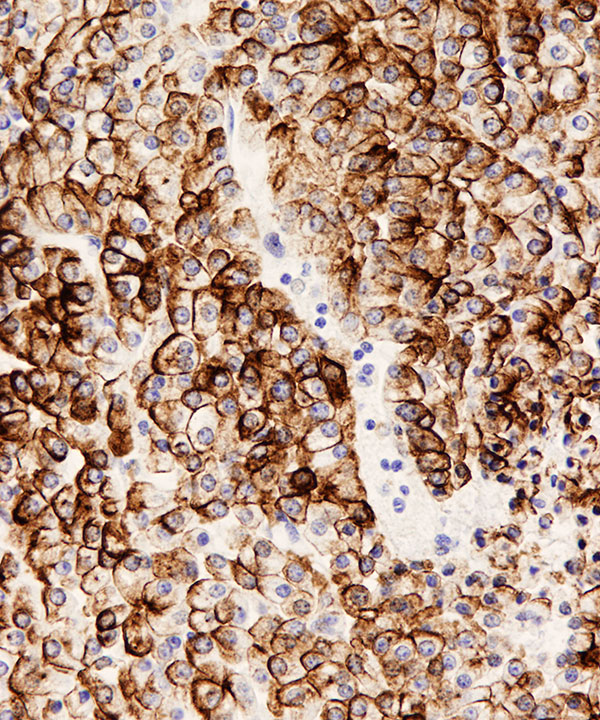09 : Liver Hepatocellular Carcinoma