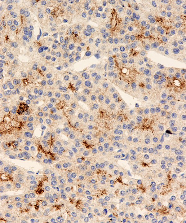11 : Liver Hepatocellular Carcinoma