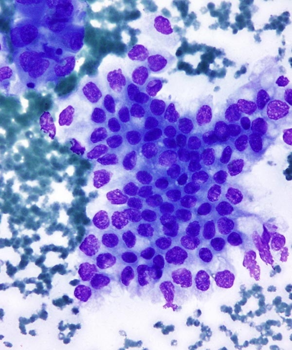 image showing 'Adenocarcinoma'