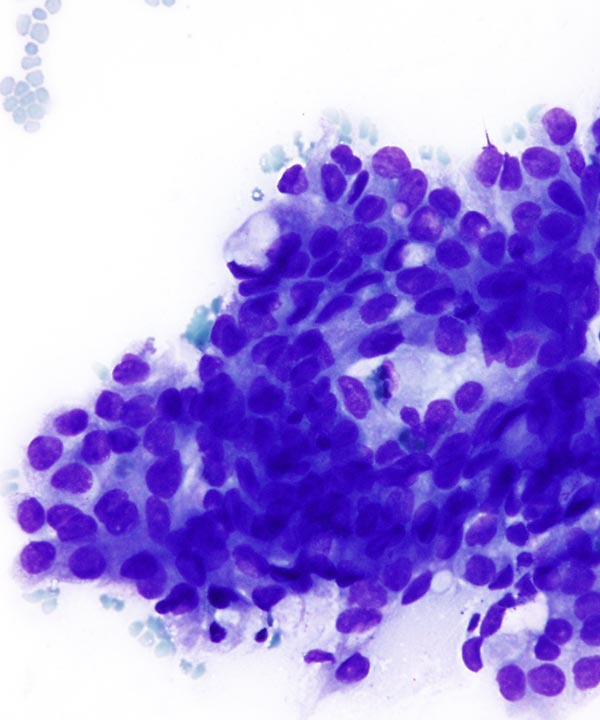 2 : Lung Adenocarcinoma
