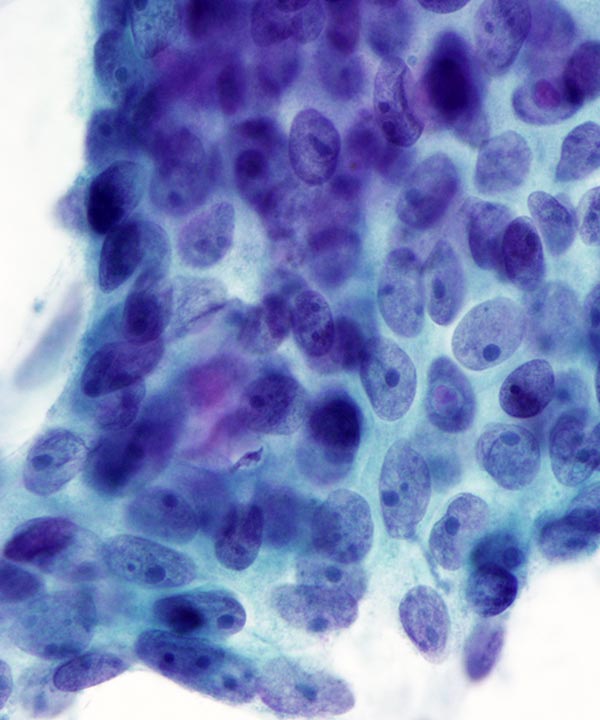 3 : Lung Adenocarcinoma
