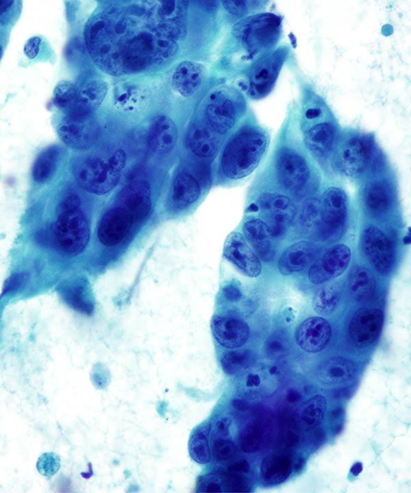 4 : Lung Adenocarcinoma