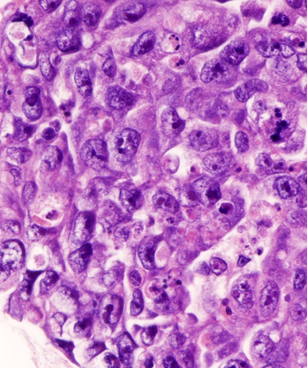 5 : Lung Adenocarcinoma
