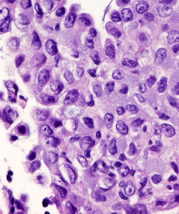 6 : Lung Adenocarcinoma