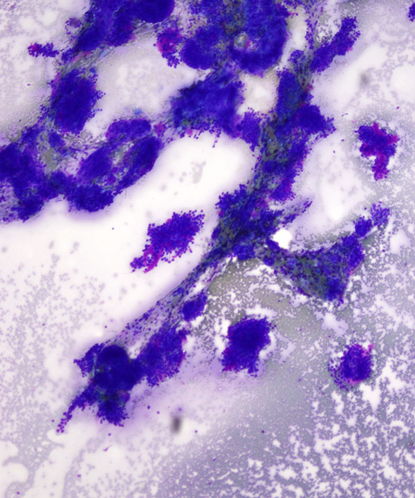 image showing 'Lung Adenoid Cystic Carcinoma'