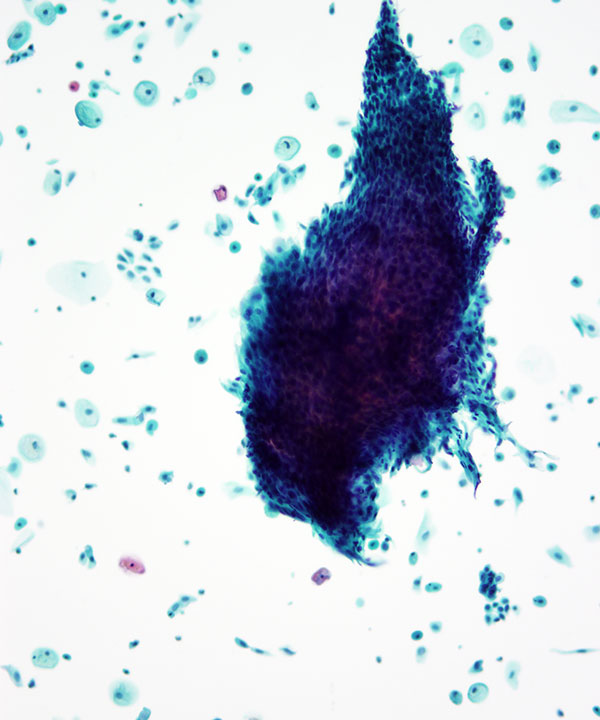 11 :  Lung Granulomatous Inflammation