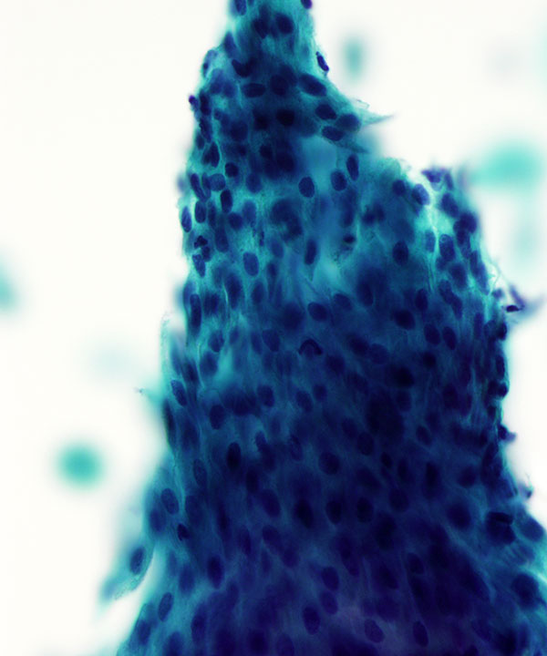 12 :  Lung Granulomatous Inflammation