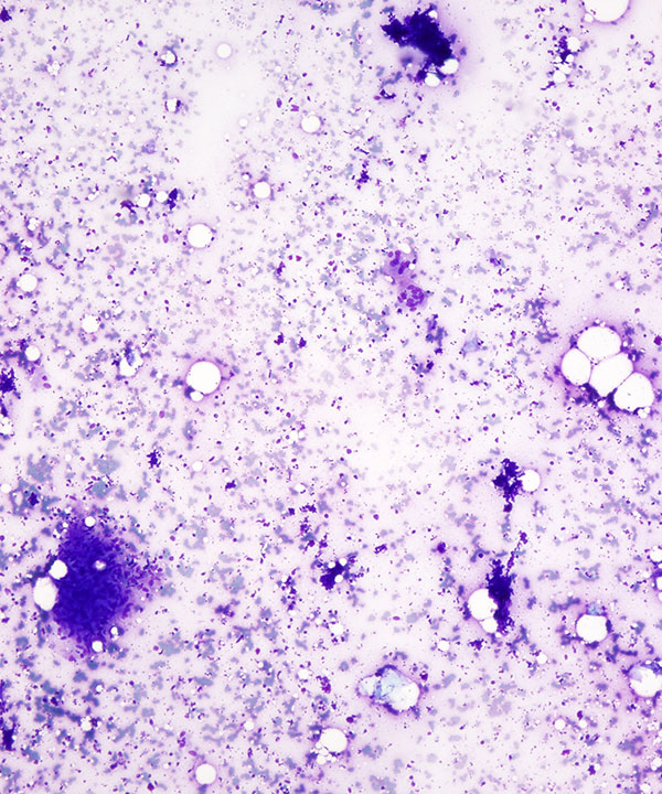 image showing 'Granulomatous Inflammation'