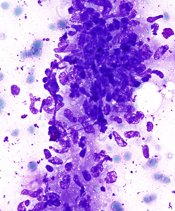 03 :  Lung Granulomatous Inflammation