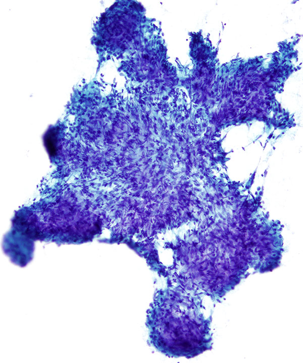 05 :  Lung Granulomatous Inflammation