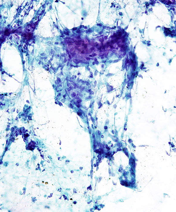 06 :  Lung Granulomatous Inflammation
