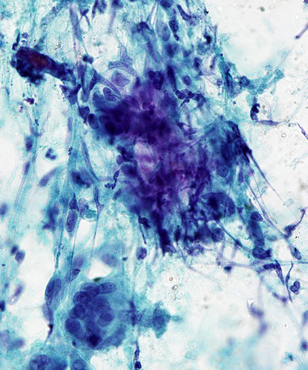 08 :  Lung Granulomatous Inflammation