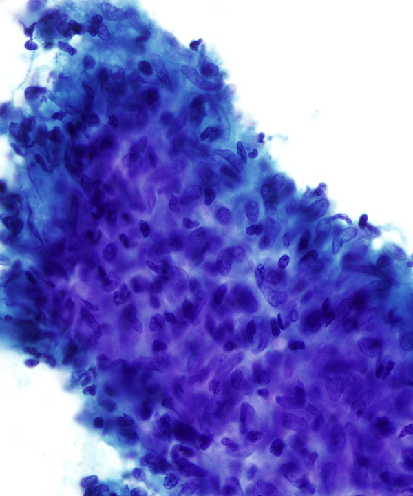 09 :  Lung Granulomatous Inflammation