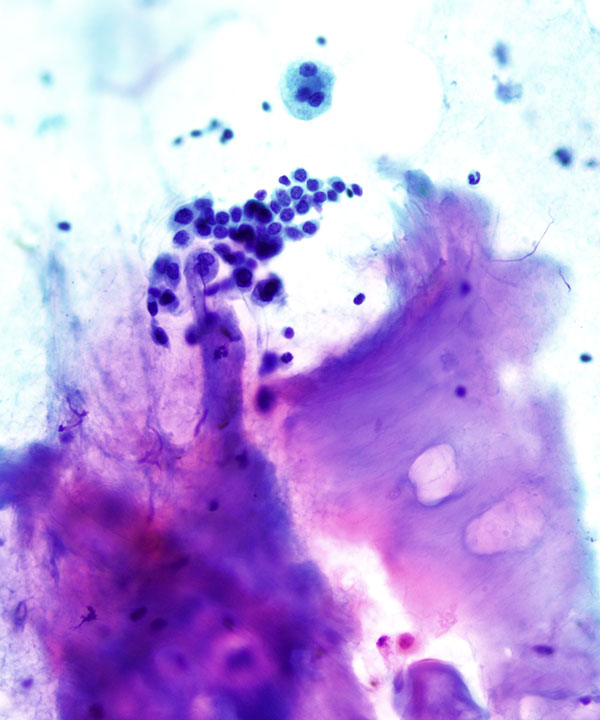 image showing 'Hamartoma'