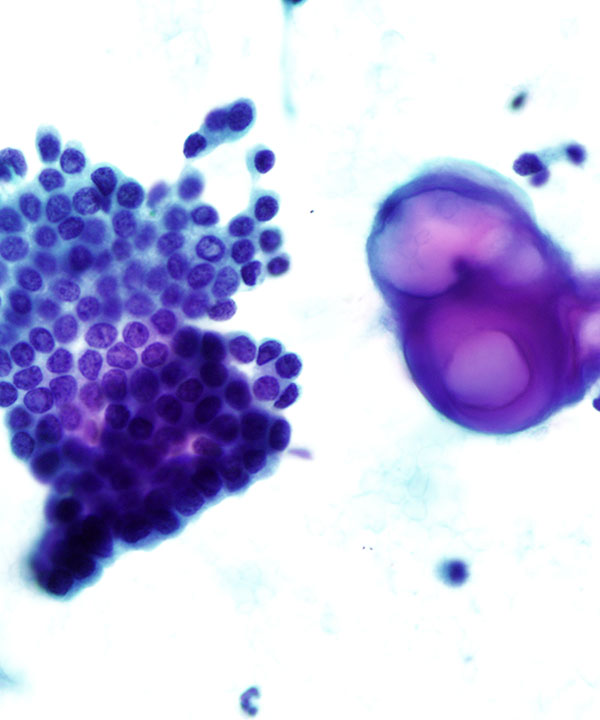 2 : Lung Hammartoma