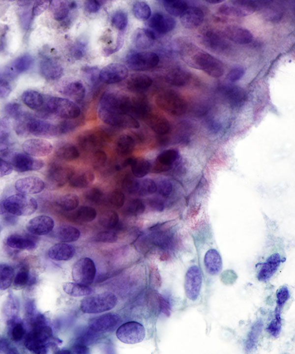 4 : LungNormanReactiveBronchialCells