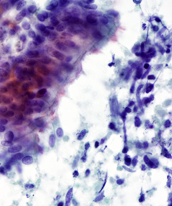 6 : LungNormanReactiveBronchialCells