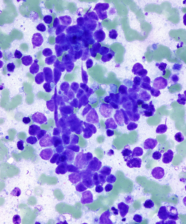 3 : Lung Small Cell Carcinoma