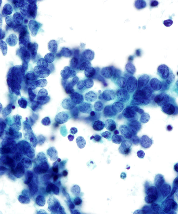 6 : Lung Small Cell Carcinoma