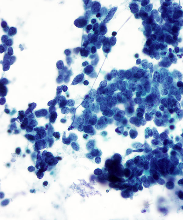 7 : Lung Small Cell Carcinoma