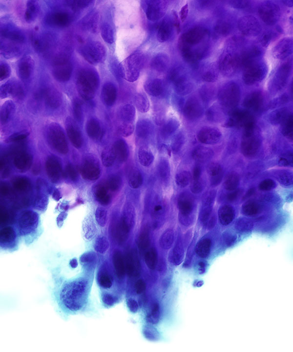 04 : Lung Squamous Cell Carcinoma