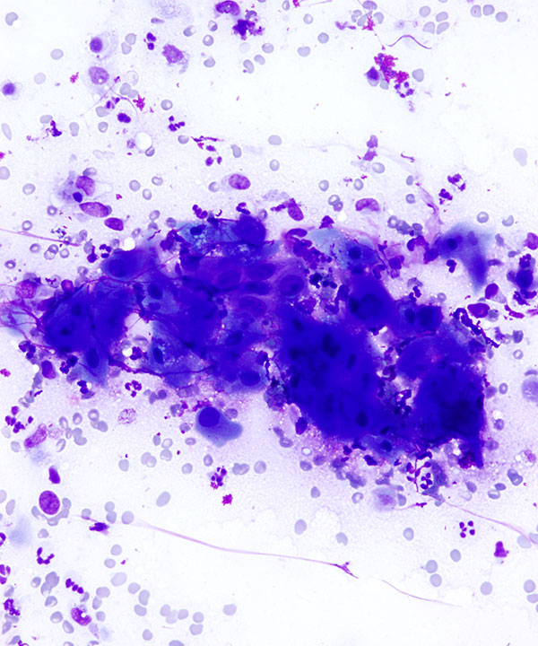 07 : Lung Squamous Cell Carcinoma