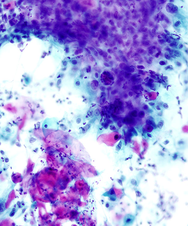 08 : Lung Squamous Cell Carcinoma