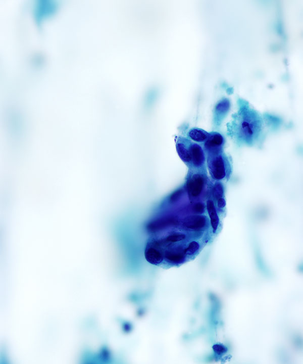 12 : Lung Squamous Cell Carcinoma