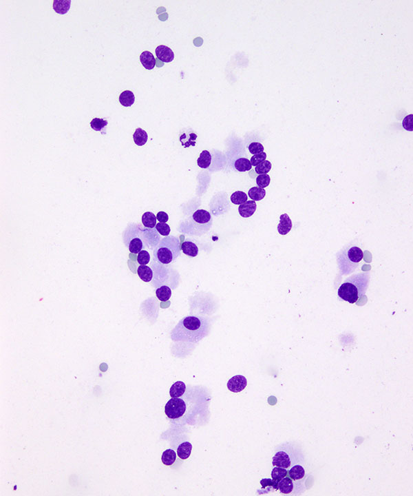 3 : Lung Neuroendocrine Tumor - Low Grade