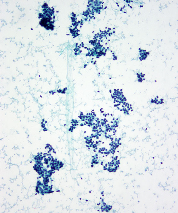 4 : Lung Neuroendocrine Tumor - Low Grade