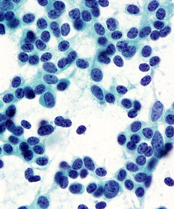 image showing 'Neuroendocrine Tumor - Low Grade'