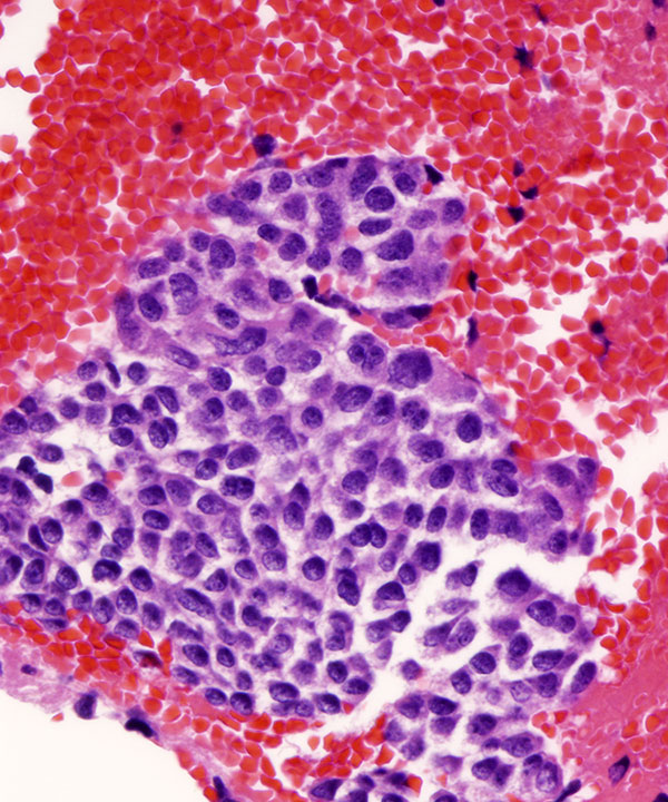 6 : Lung Neuroendocrine Tumor - Low Grade