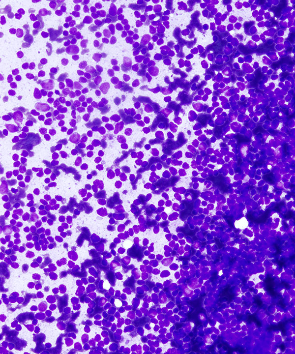image showing 'Mediastinal Lymphoblastic Lymphoma'