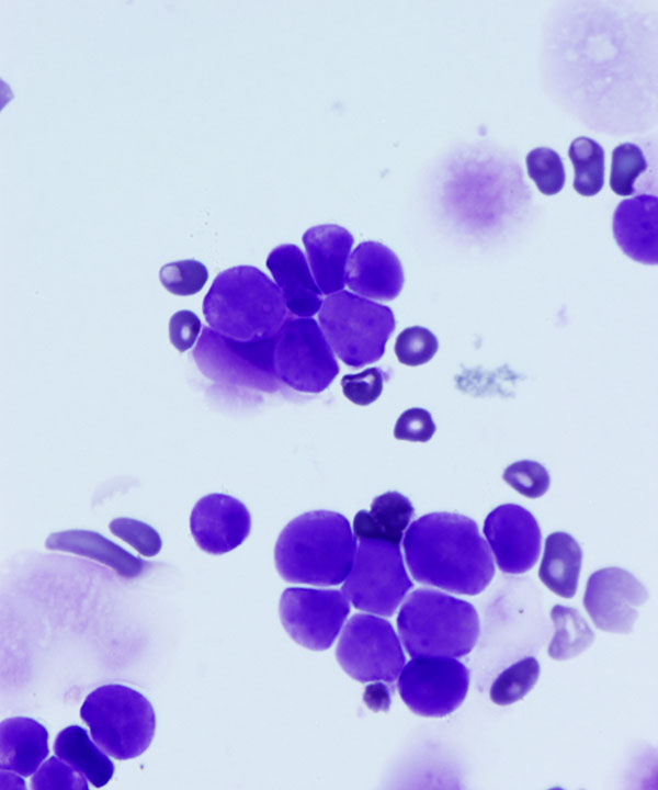 05 : Mediastinal Lymphoblastic Lymphoma