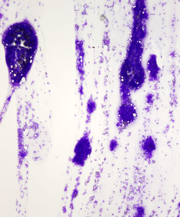 image showing 'Thymoma'