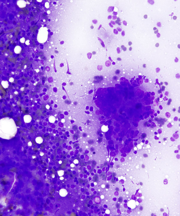 02 : Mediastinum Thymoma