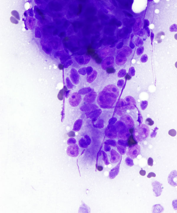 03 : Mediastinum Thymoma