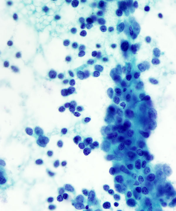 05 : Mediastinum Thymoma