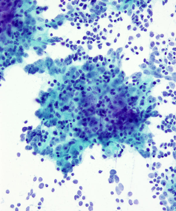 07 : Mediastinum Thymoma