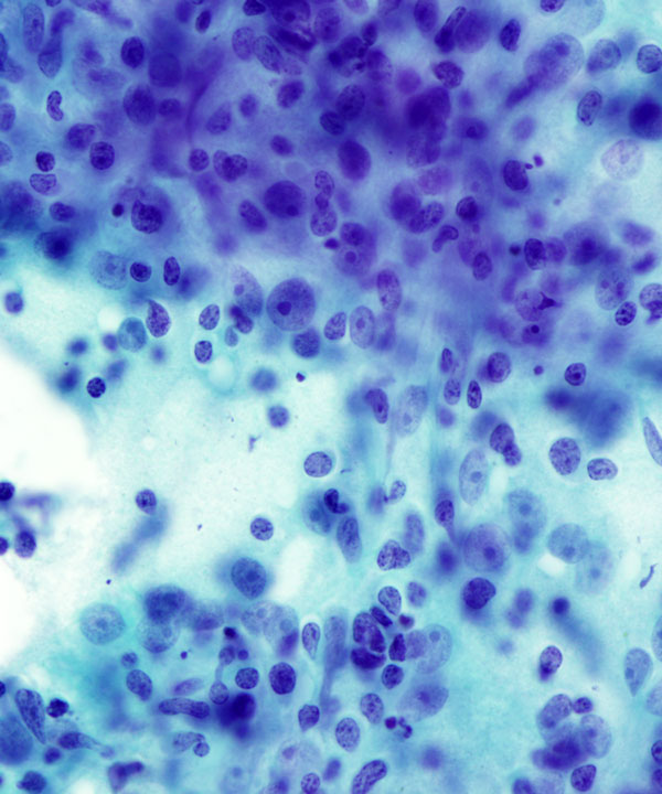 08 : Mediastinum Thymoma
