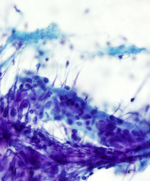 09 : Mediastinum Thymoma